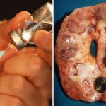 testosterone-replacement-therapy-&-urinary-stones